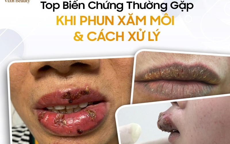 Top 8 Biến Chứng Thường Gặp Khi Phun Xăm Môi & Cách Xử Lý
