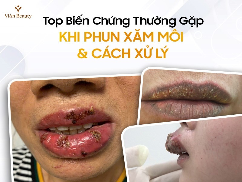 Top 8 Biến Chứng Thường Gặp Khi Phun Xăm Môi & Cách Xử Lý